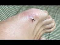 Video thumbnail for Satisfying Splinter Removal Video - big splinter in foot