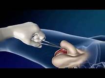 Video thumbnail for Gender Reassignment Surgery | Conversion from male to female