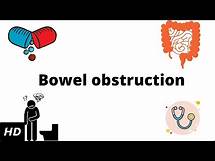 Video thumbnail for Bowel Obstruction, Causes, Signs and Symptoms, Diagnosis and Treatment.