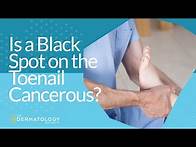 Video thumbnail for Is a Black Spot on the Toenail Cancerous?