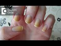 Video thumbnail for What can cause yellow discoloration of nails with dizziness and blackouts? - Dr. Sharat Honnatti