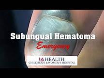 Video thumbnail for Subungual Hematoma Emergency and Trephination Procedure