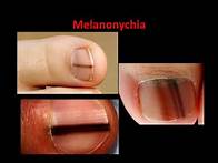 Video thumbnail for Melanoma (Melanonychia) - What is it