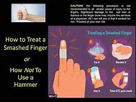 Video thumbnail for How to treat a smashed finger that get hit