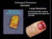 Video thumbnail for Subungual Hematoma - Everything You Need To Know - Dr. Nabil Ebraheim