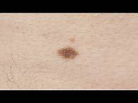 Video thumbnail for Melanoma symptoms: How to spot signs, and when to see a doctor