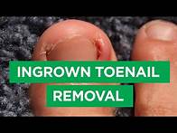 Video thumbnail for Ep. 59: Ingrown Toenail Removal Procedure | The Scope