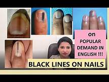 Video thumbnail for Black lines on nails: what to do?- MBBS MD (MAMC) (SKIN)- ENGLISH 2022
