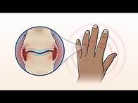 Video thumbnail for What Is Rheumatoid Arthritis? | NEJM