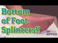 Video thumbnail for How to get splinters out foot? Dr Nail Nipper and 30 Splinters on Bottom [Callus Tuesday] (2021)