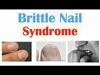 Video thumbnail for Brittle Nail Syndrome | Causes, Signs & Symptoms, Diagnosis, Treatment, Supplements