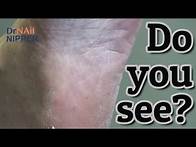 Video thumbnail for Splinter in the Heel. Who removes splinters? Dr Nail Nipper (2021)