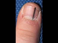 Video thumbnail for Dermatology: (Wk8)(Wed)(Spr20): Anatomy of the Nail Then Learn About Melanonychia.