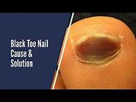 Video thumbnail for BLACK TOE NAILS - CAUSES AND SOLUTIONS