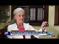 Video thumbnail for Checking your fingernails for signs of Melanoma
