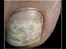 Video thumbnail for Keratin Granulations = White Toenails [Best Home Treatment]