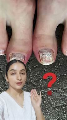 Video thumbnail for Dr.Shivani Kanwar on Instagram: "📝 What is this? Keratin granulation is a temporary nail condition where the surface appears white, rough, and flaky due to overuse of nail polish and harsh removers. It occurs when the keratin protein gets disrupted, leading to dryness. --- 🚫 What to Avoid? ❌ Frequent Nail Polish Use – Suffocates the nails. ❌ Acetone-Based Nail Polish Removers – Causes excessive dryness. ❌ Peeling Off Nail Polish – Damages the top nail layer. ❌ Excessive Buffing – Thins and wea