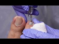 Video thumbnail for SATISFYING RELEASE OF BLOOD BLISTER UNDERNEATH TOENAIL!