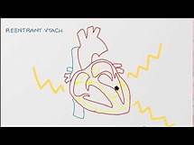 Video thumbnail for Ventricular Tachycardia - Types, Causes, and Treatment Approaches