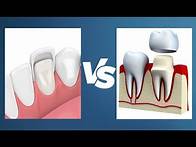 Video thumbnail for Veneers vs Crowns - Whats the Difference?