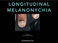 Video thumbnail for Nails: Longitudinal Melanonychia