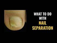 Video thumbnail for NAIL SEPARATION - What to DO and What are the CAUSES?