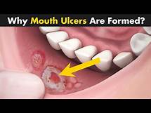 Video thumbnail for Mouth Ulcers | Mouth Ulcers Symptoms, Causes And Treatment | Demystifying science