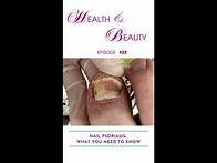 Video thumbnail for Nail Psoriasis: What You Need to Know.