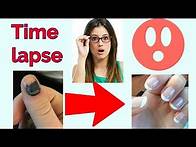 Video thumbnail for Time Lapse of Smashed Nail/subungual hematoma/