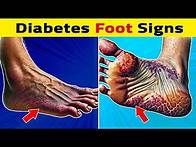 Video thumbnail for 10 Signs Your Feet Tell You About Diabetes!