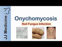 Video thumbnail for Onychomycosis | Nail Infection | Signs, Symptoms, Treatment