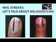 Video thumbnail for Streaks in Your Nails? Let's Talk about Melanonychia. We'll Also Look at Skin Tags & Skin Polyps