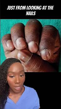 Video thumbnail for Could this be Cancer!? Melanonychia can be a benign or potentially serious condition #melanonychia