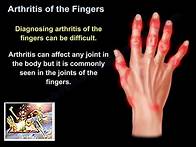 Video thumbnail for Arthritis Of The Fingers - Everything You Need To Know - Dr. Nabil Ebraheim