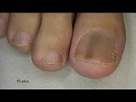Video thumbnail for Melanoniquia Longitudinal : when sospectar un melanoma subungueal ? - Dr Horacio CABO