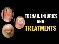 Video thumbnail for How do I treat a toenail injury?