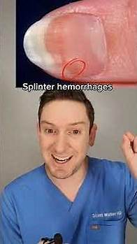 Video thumbnail for HOW TO TELL if you have NAIL FUNGUS or NAIL PSORIASIS?! A dermatologist explains. #nailfungus