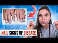 Video thumbnail for Doctor Explains what your NAILS say about your HEALTH: Top 10 Nail Problems