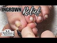 Video thumbnail for Squeezed Ingrown Toenail #nails #satisfying