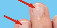 Video thumbnail for Here's what those white marks on your nails say about your health