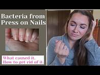Video thumbnail for AVOID Nail Bacteria from Press on Nails | What I did | How to get rid of it