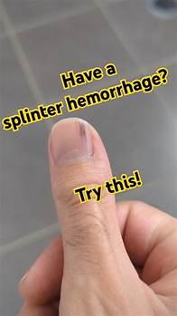 Video thumbnail for Your splinter hemorrhage might have a surprising cause... 🦷 Watch to find out! #NailHealth #Gums