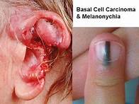 Video thumbnail for Basal Cell Carcinoma & Melanonychia (Nail Lines): Updated