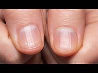 Video thumbnail for If You Have Ridges On Your Fingernails It Means This