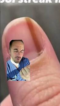 Video thumbnail for Subungual melanoma in the nail !? Doctor reacts #striate melanonychia #subungualmelanoma
