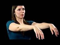 Video thumbnail for Drug-Induced Movement Disorders: DISCUS Sample 2