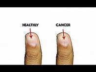 Video thumbnail for 9 Fingernails serious alarming health issues and probllems