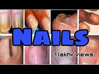 Video thumbnail for Nails disorders , Nails diseases and differential diagnosis || Mis.Medicine