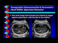 Video thumbnail for Gestational Age Determination by Ultrasound