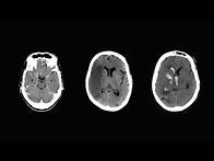 Video thumbnail for How to Read a CT Scan of the Head - MEDZCOOL